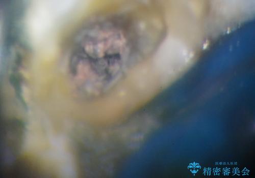 繰り返す痛み 下顎小臼歯の再根管治療の治療前