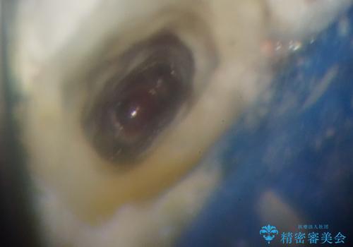 繰り返す痛み 下顎小臼歯の再根管治療の治療中