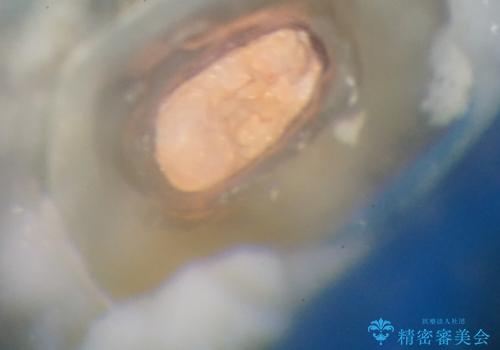 繰り返す痛み 下顎小臼歯の再根管治療の治療後