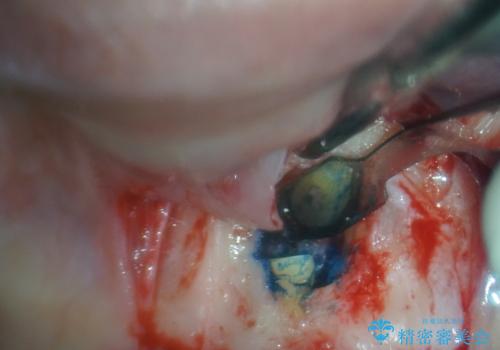 膿の出口が気になるセラミッククラウンの前歯 歯根端切除術で解決の治療中