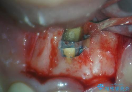 膿の出口が気になるセラミッククラウンの前歯　歯根端切除術で解決の治療中