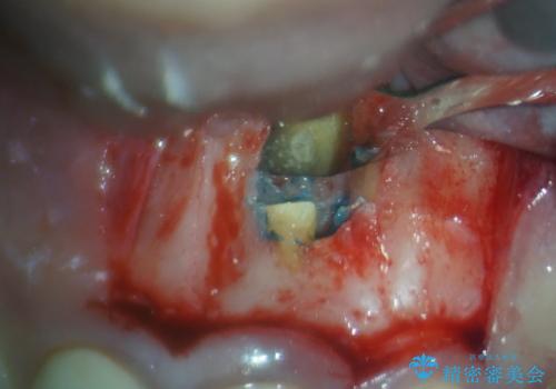 膿の出口が気になるセラミッククラウンの前歯 歯根端切除術で解決の治療中