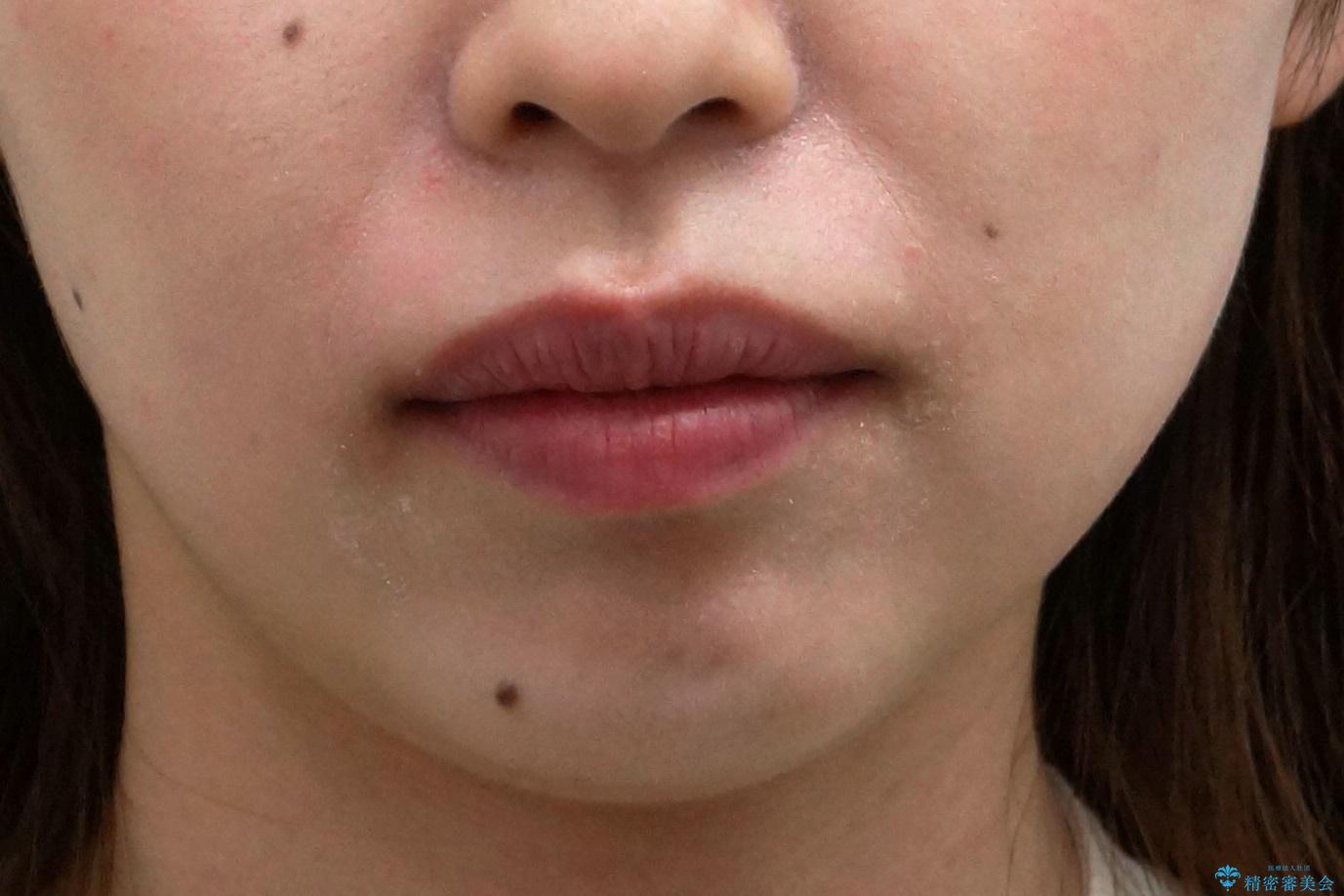 前歯の並び インビザライン 非抜歯で 深いかみ合わせの治療の治療後(顔貌)