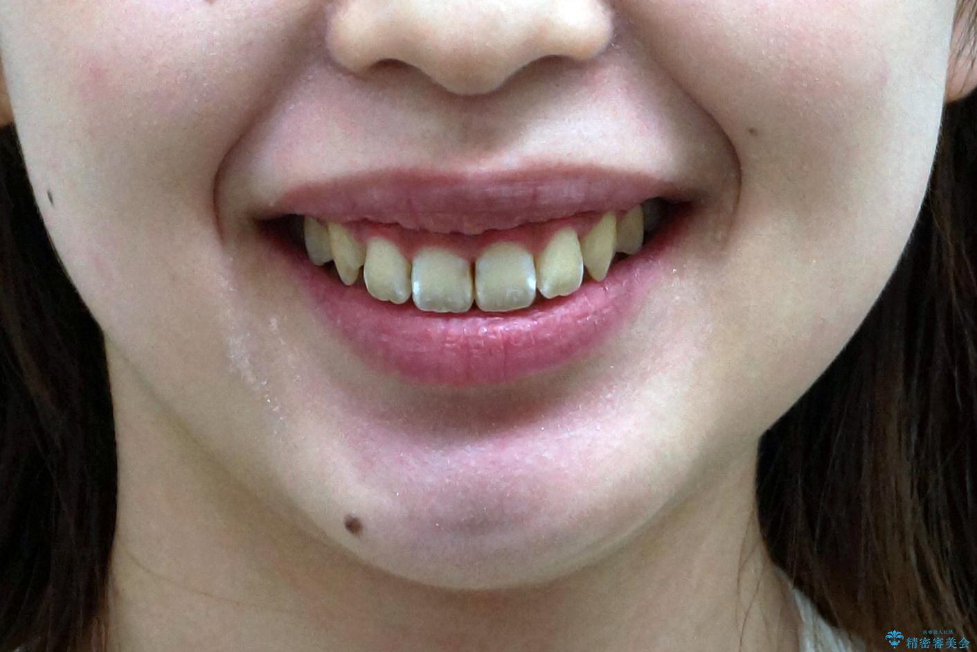 前歯の並び インビザライン 非抜歯で 深いかみ合わせの治療の治療後(顔貌)