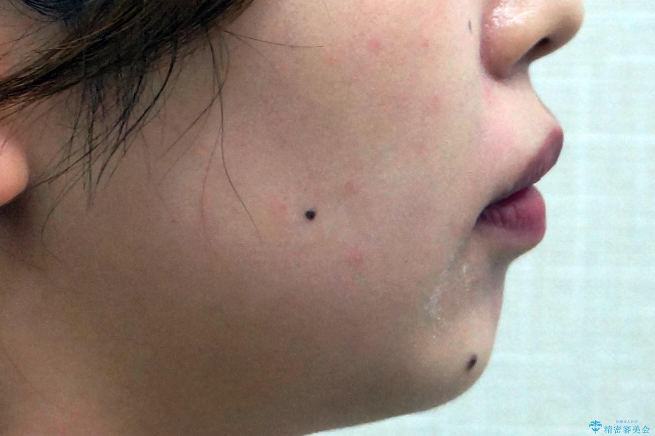 前歯の並び インビザライン 非抜歯で 深いかみ合わせの治療の治療後(顔貌)