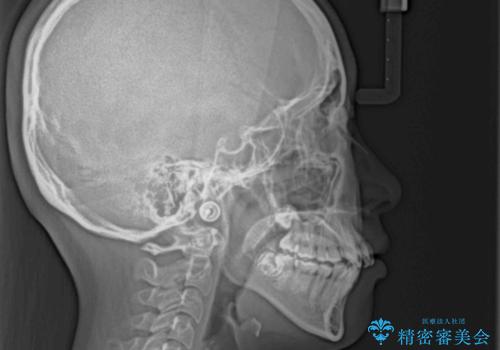 デコボコと出っ歯 抜歯矯正でスッキリとした口元にの治療前