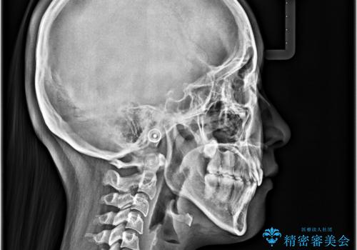 デコボコと出っ歯 抜歯矯正でスッキリとした口元にの治療後