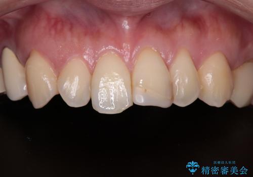 前歯をきれいにしたい オールセラミッククラウンの治療前
