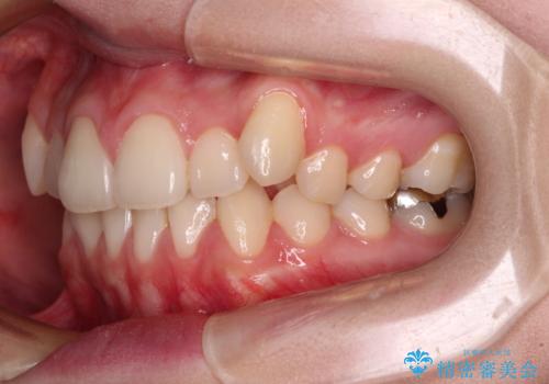 八重歯を確実に改善 補助装置を併用したインビザライン矯正治療の治療前