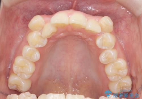 [ 八重歯を治す ]   小臼歯4本抜歯 マルチブラケット矯正の治療前
