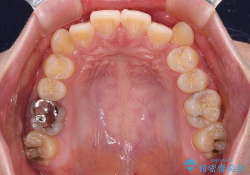 八重歯を確実に改善　補助装置を併用したインビザライン矯正治療の治療前