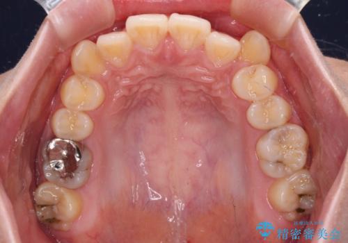 八重歯を確実に改善 補助装置を併用したインビザライン矯正治療の治療前