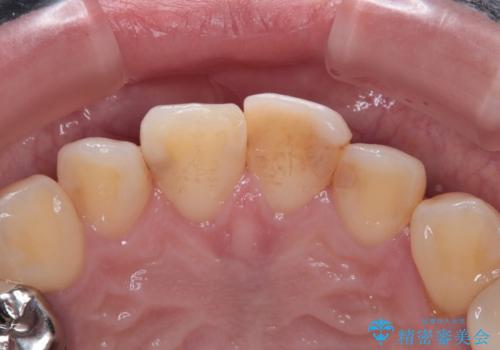 前歯をきれいにしたい オールセラミッククラウンの治療前