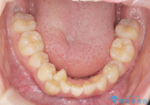 [ 八重歯を治す ]   小臼歯4本抜歯 マルチブラケット矯正の治療前