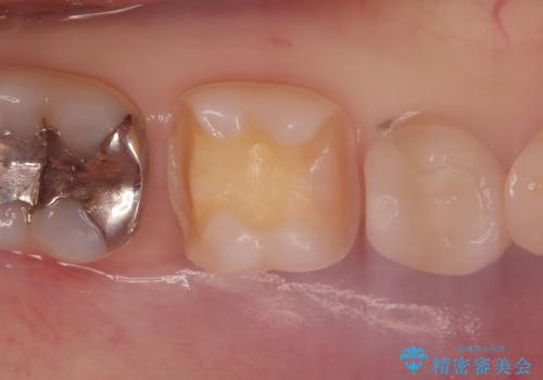 【セラミックインレー】口の中を白くしたいの治療前