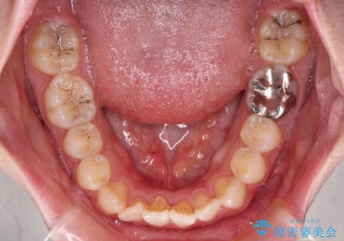 八重歯を確実に改善 補助装置を併用したインビザライン矯正治療の治療前