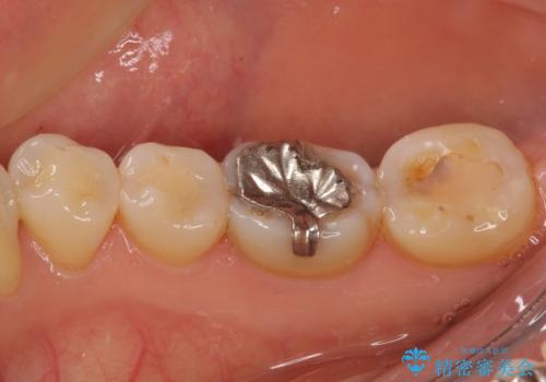奥歯の銀歯をゴールドでしっかりと治療の治療前