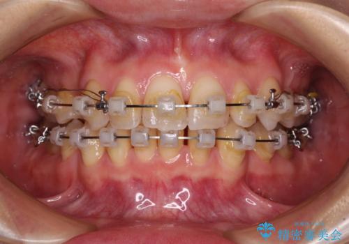 【モニター】顎のゆがみをカムフラージュ ワイヤー装置の抜歯矯正の治療中
