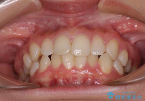 埋もれた奥歯をワイヤーで改善 インビザラインによる矯正治療の治療前