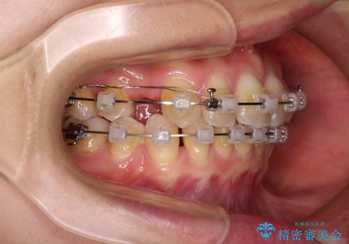 【モニター】顎のゆがみをカムフラージュ ワイヤー装置の抜歯矯正の治療中