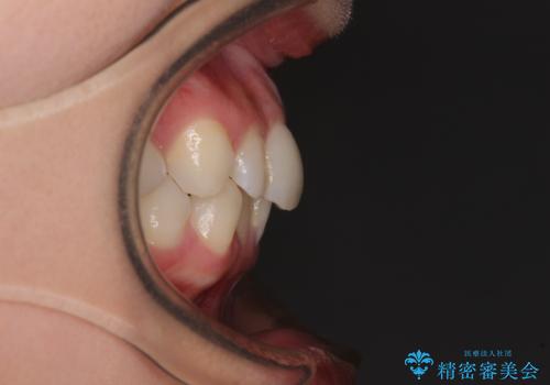 埋もれた奥歯をワイヤーで改善 インビザラインによる矯正治療の治療前