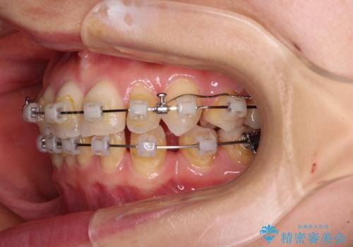 【モニター】顎のゆがみをカムフラージュ　ワイヤー装置の抜歯矯正の治療中
