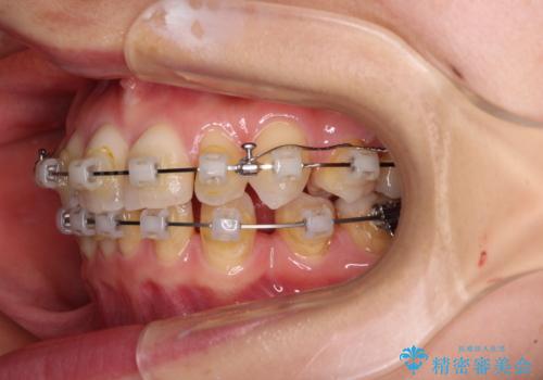 【モニター】顎のゆがみをカムフラージュ ワイヤー装置の抜歯矯正の治療中