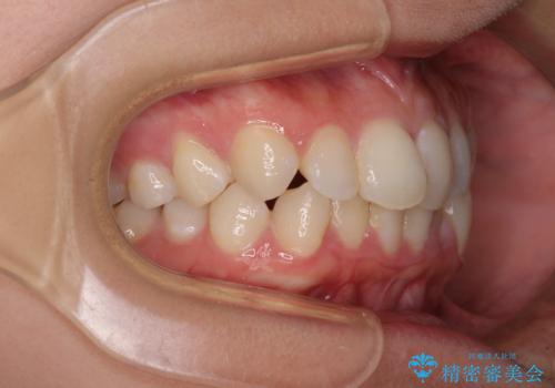 埋もれた奥歯をワイヤーで改善 インビザラインによる矯正治療の治療前