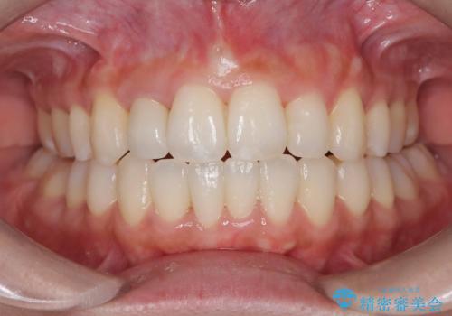 【オールセラミッククラウン】前歯の見た目が気になる!の症例 治療後