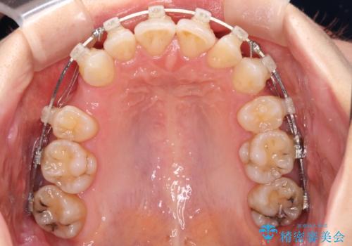 【モニター】顎のゆがみをカムフラージュ ワイヤー装置の抜歯矯正の治療中