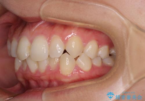 埋もれた奥歯をワイヤーで改善 インビザラインによる矯正治療の治療前