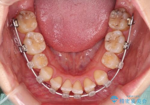 【モニター】顎のゆがみをカムフラージュ ワイヤー装置の抜歯矯正の治療中