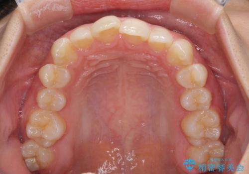 埋もれた奥歯をワイヤーで改善 インビザラインによる矯正治療の治療前