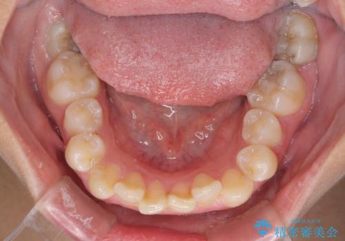 埋もれた奥歯をワイヤーで改善 インビザラインによる矯正治療の治療前