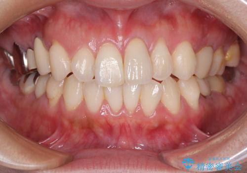 前歯をきれいにしたい オールセラミッククラウン