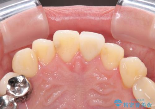 前歯をきれいにしたい オールセラミッククラウンの治療後