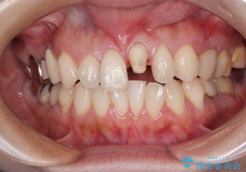 前歯をきれいにしたい オールセラミッククラウンの治療中