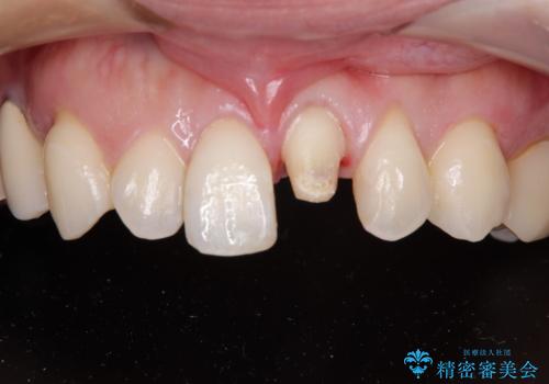 前歯をきれいにしたい オールセラミッククラウンの治療中
