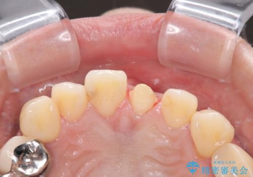 前歯をきれいにしたい オールセラミッククラウンの治療中