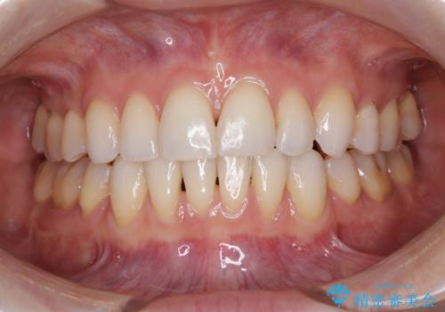 【モニター】顎のゆがみをカムフラージュ　ワイヤー装置の抜歯矯正の症例 治療後