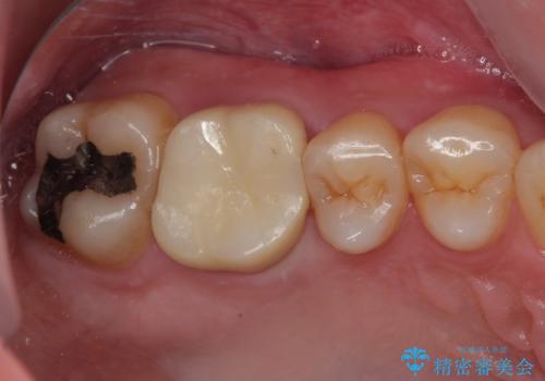 歯が割れた オールセラミッククラウンの症例 治療後