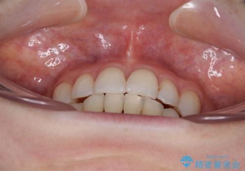 【モニター】顎のゆがみをカムフラージュ ワイヤー装置の抜歯矯正の治療後