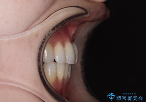 【モニター】顎のゆがみをカムフラージュ ワイヤー装置の抜歯矯正の治療後