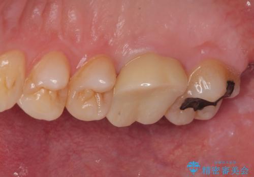 歯が割れた オールセラミッククラウンの治療後
