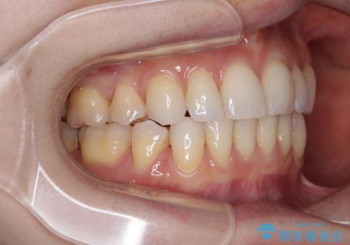 【モニター】顎のゆがみをカムフラージュ ワイヤー装置の抜歯矯正の治療後