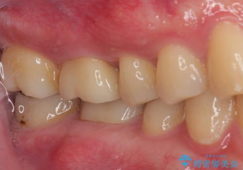 歯が割れた オールセラミッククラウンの治療後