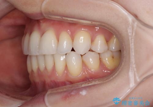 【モニター】顎のゆがみをカムフラージュ ワイヤー装置の抜歯矯正の治療後