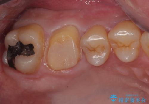 歯が割れた　オールセラミッククラウンの治療中