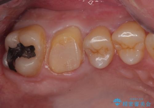 歯が割れた オールセラミッククラウンの治療中