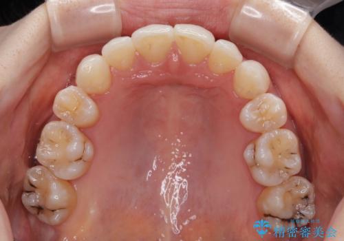 【モニター】顎のゆがみをカムフラージュ ワイヤー装置の抜歯矯正の治療後